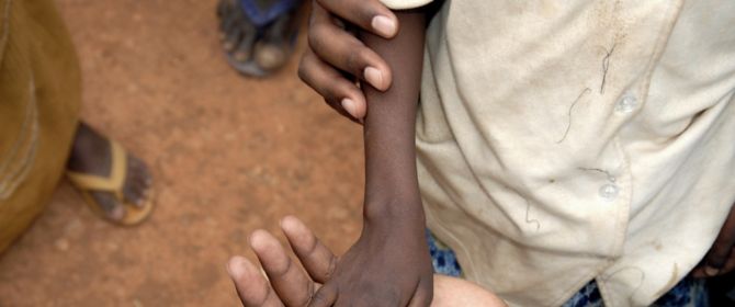 A thin refugee child's hand lies in the palm of an adults hand - Somalia refugee camp